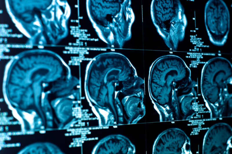 Killer brain tumours surge more than 50% over the last decade