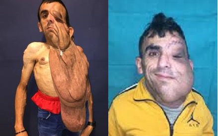 ‘New life’ for man who had massive tumour removed from face