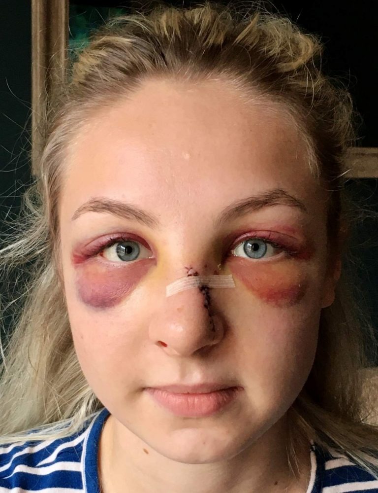 Anger as Teen Avoids Jail After Savagely Wounding a Police Officer