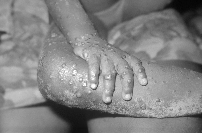 Two Cases Of Monkeypox Identified In North Wales