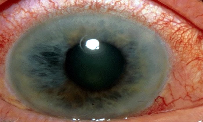 New genetic test to detect glaucoma is 15 times more effective