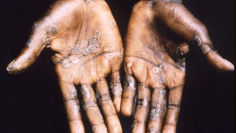 Rare monkeypox case confirmed in the US