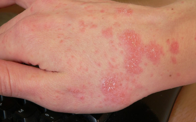 Scabies could be on the increase in Spain