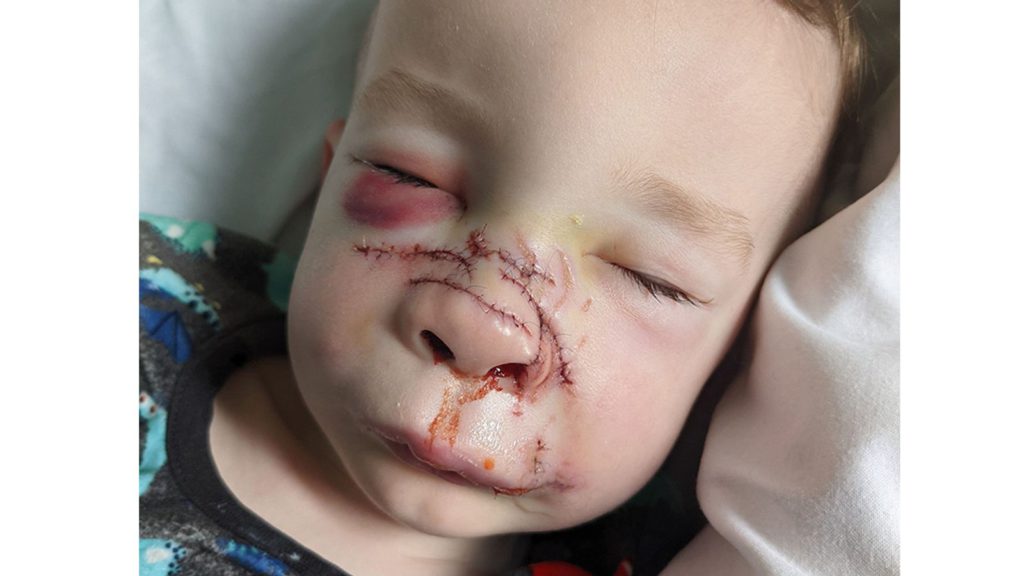 Toddler’s nose ripped from single bite by “best friend” pet dog