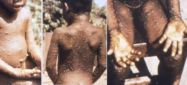 Second case of monkeypox diagnosed in London