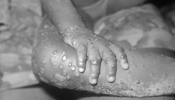 Spain confirms the first death from monkeypox in Europe