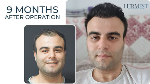 Cost of top 5 best hair transplant clinics & surgeons in Istanbul Turkey