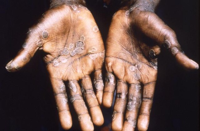 Monkeypox to be renamed and possibly classed as an 'international health emergency'