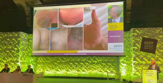 Spanish Academy of Dermatology congress in Malaga addresses the use of AI