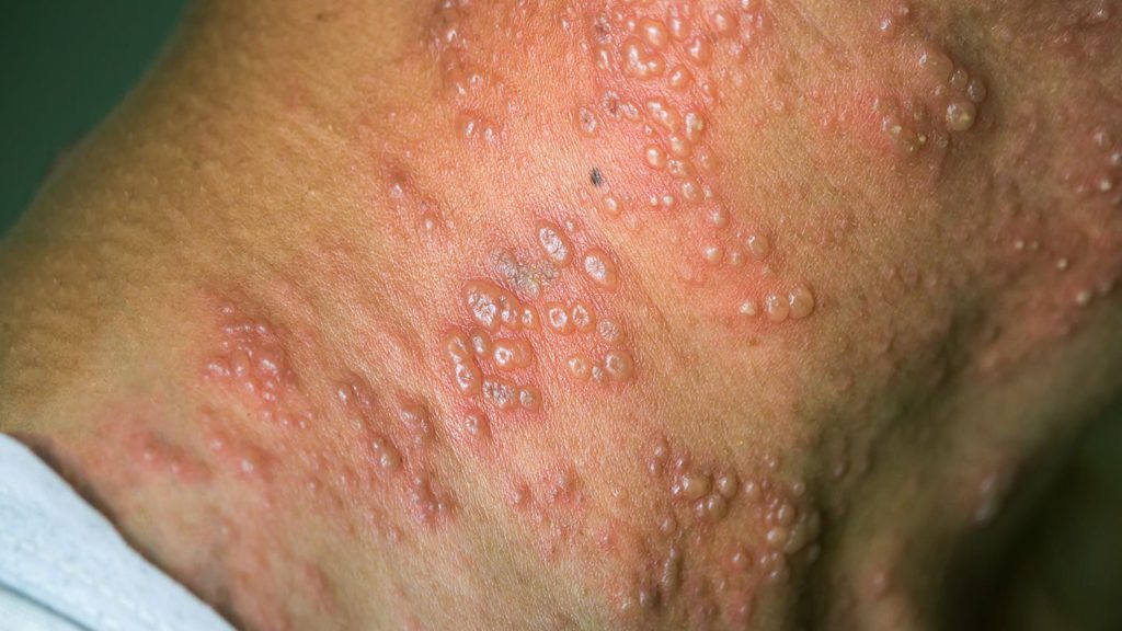 Monkeypox cases reach over three thousand with Europe most affected