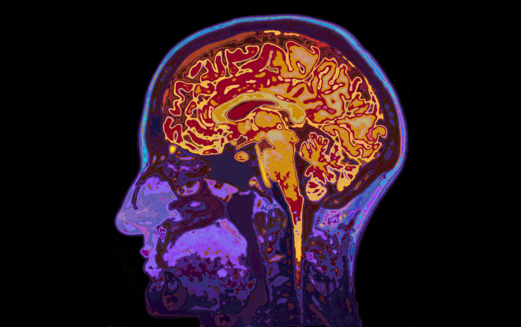 Covid-19 patients have increased risk of developing brain disorders