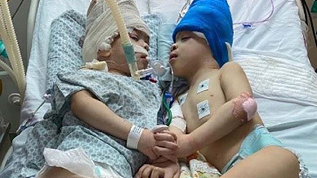 Ground-breaking operation successfully separates conjoined twins who shared fused brains