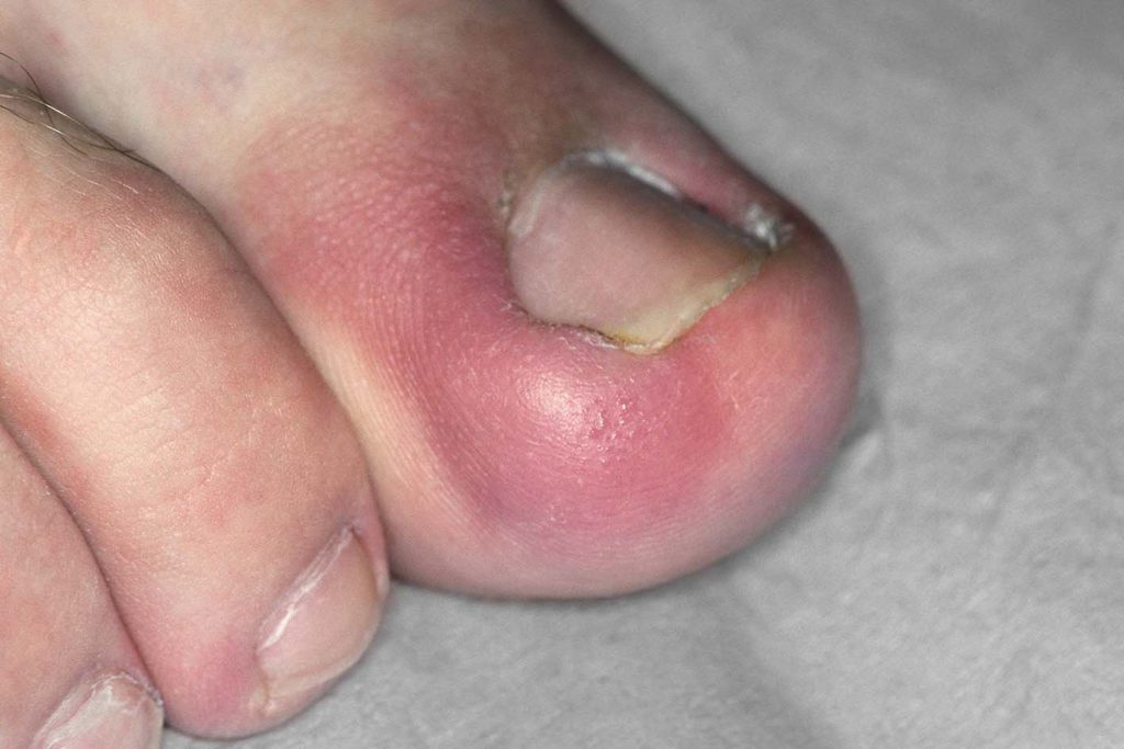 The curse of an ingrown toenail