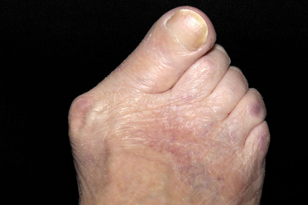 How to keep the dreaded bunion pain at bay