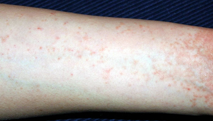 Scabies outbreaks in the Balearic Islands doubled in the last 12 months