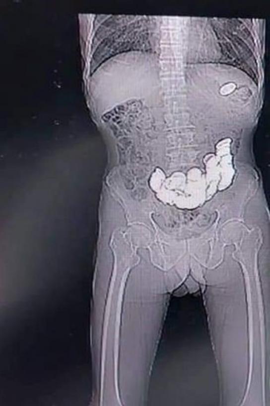 Severe abdominal pains scan reveals a tummy full of money