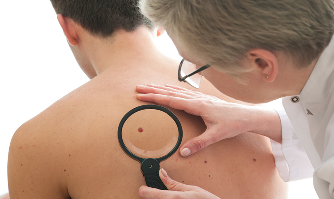 Image of a dermatologist checking for melanoma.