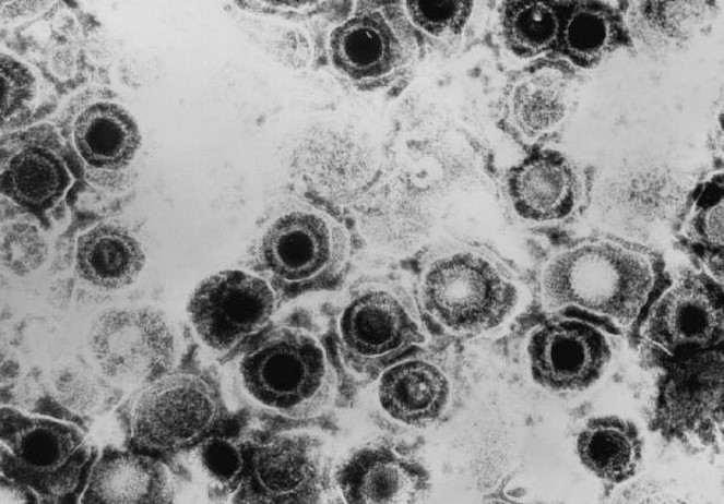Image of the herpes simplex virus.