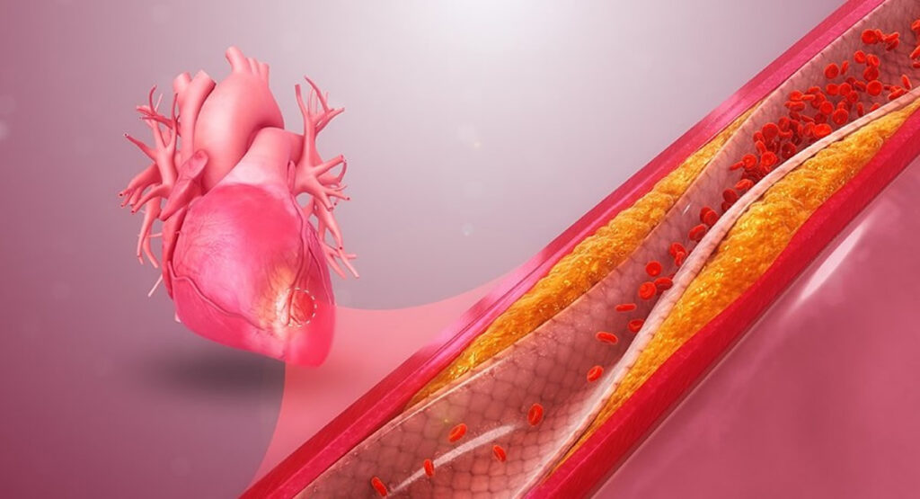Image showing reduced blood flow to heart caused by cholesterol.