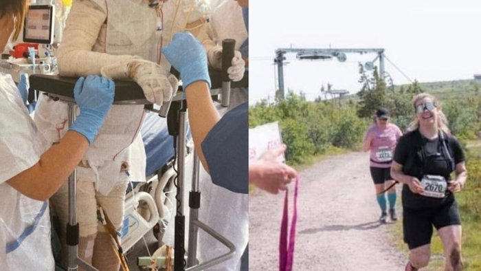 Swedish SuperWoman Walked Through Fire to Rescue Her Six Children. Six years later, Emma Schols still carries the scars with pride. Credit: Emma Schols, Instagram