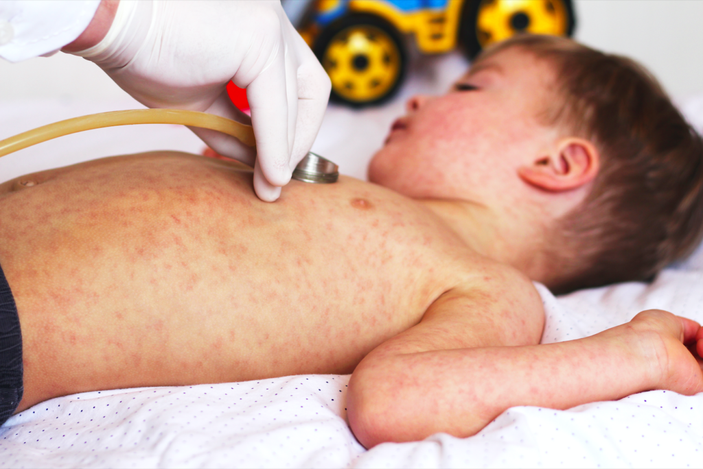 Measles Making a Comeback?! UK & Spain Lose "Elimination" Status!