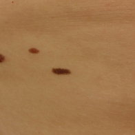Patients with many moles.