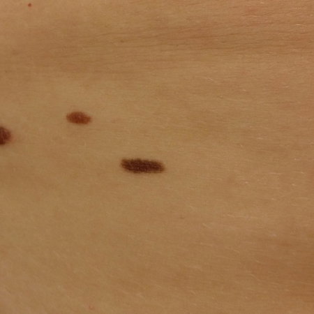 Patients with many moles.