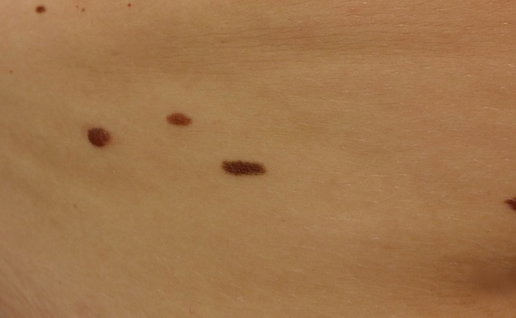 Patients with many moles.