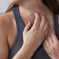 Woman suffering from rash on neck and itching