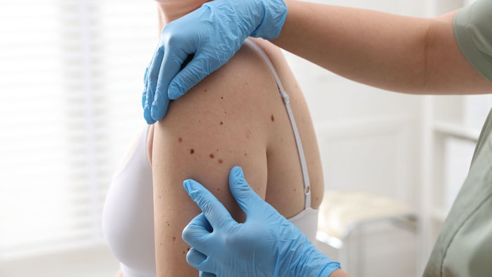 A dermatologist wearing blue medical gloves examining a woman's shoulder covered in skin moles during a skin cancer screening.