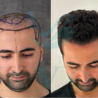 View of a before and after picture of a man getting hair transplant treatment from Este Favor in Turkey