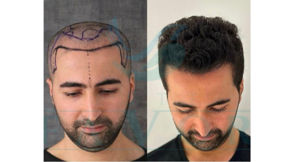 Top 10 Hair Transplant Doctors in Turkey 2026: The surgeons behind the best results