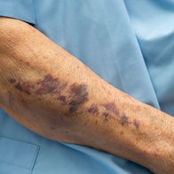 Close-up of large dark purpuric bruising on an elderly patient's forearm, illustrating increased skin bleeding risks associated with daily aspirin use.